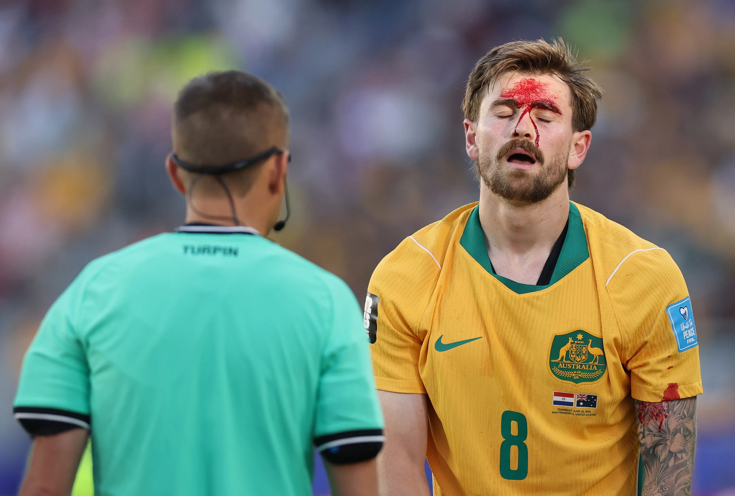 Metcalfe com o rosto cortado após choque com adversário – (Photo by Stu Forster/Getty Images)
